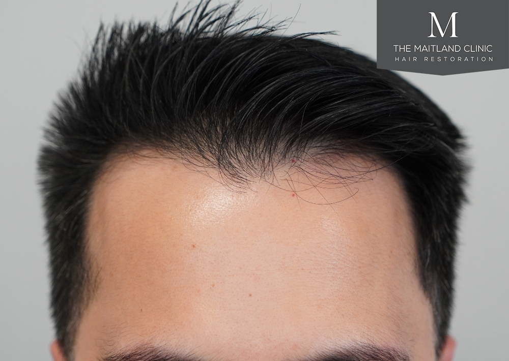 1186 grafts by FUE
