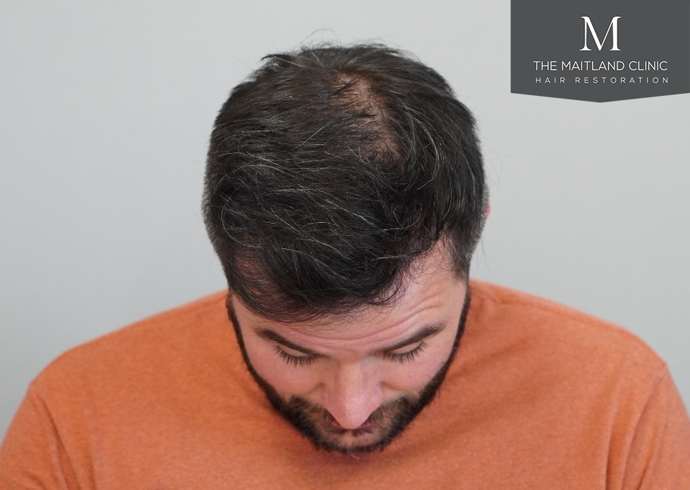 2115 grafts by FUE