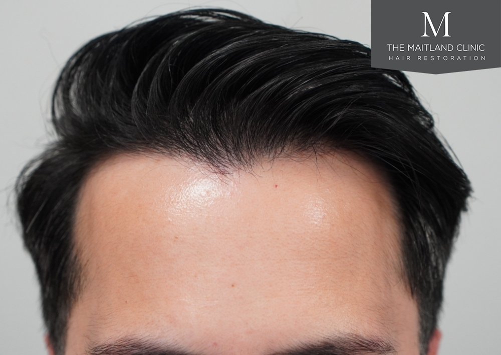 1186 grafts by FUE