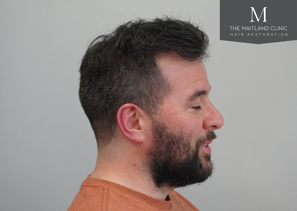 2115 grafts by FUE