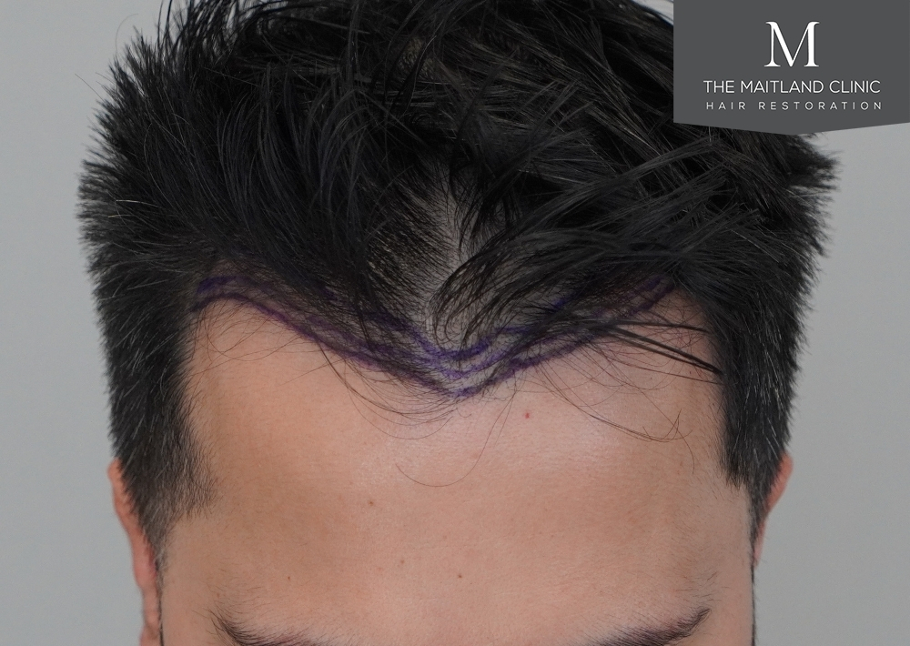 1186 grafts by FUE