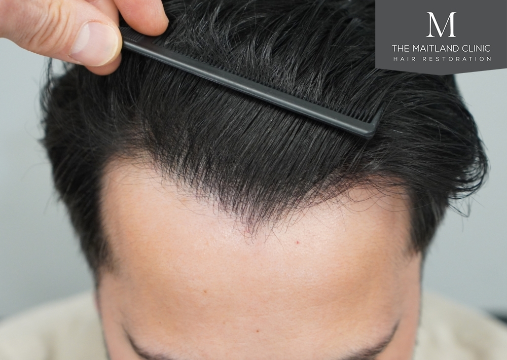 1186 grafts by FUE