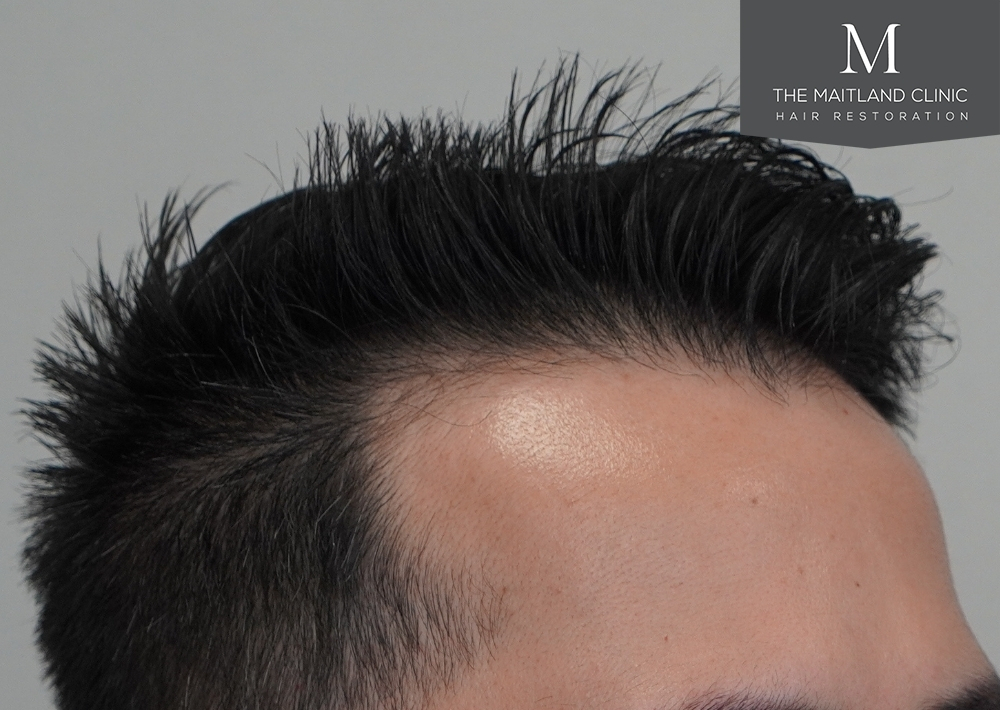 1186 grafts by FUE