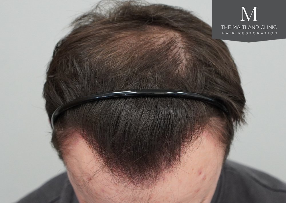 1551 grafts by FUE
