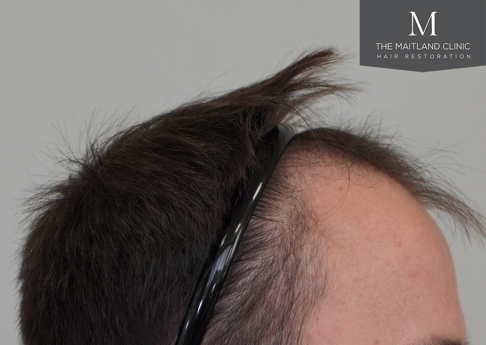 1551 grafts by FUE