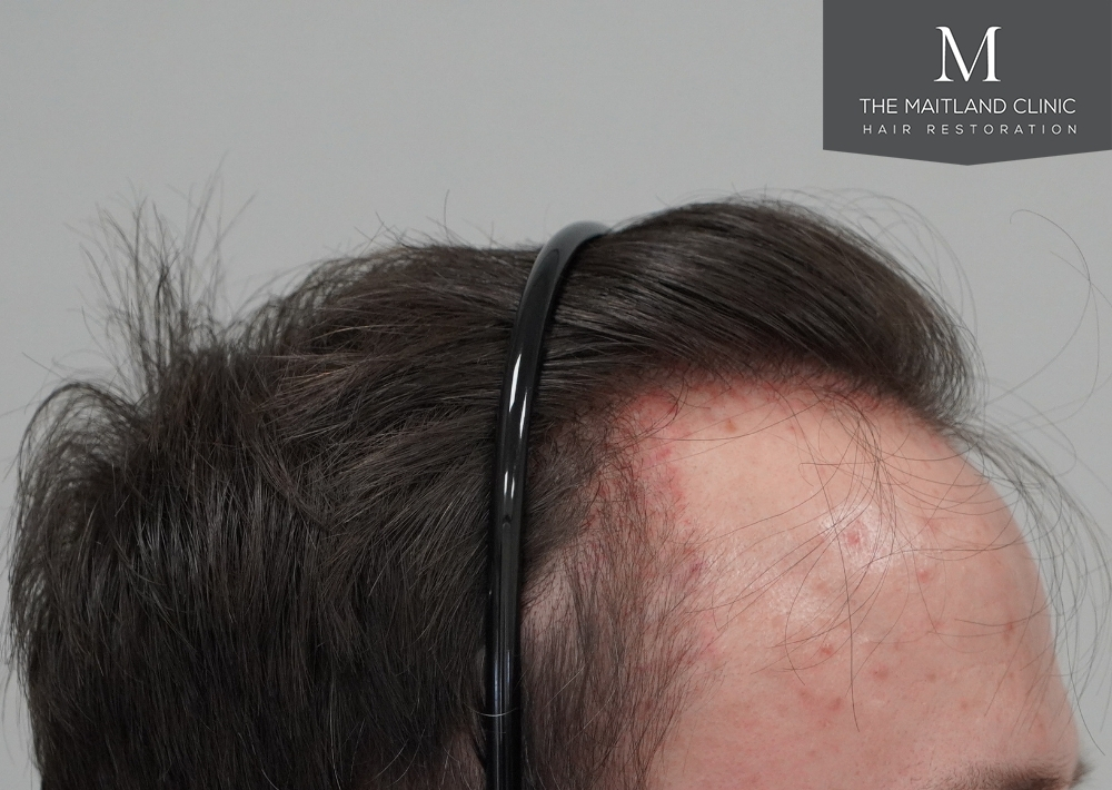 1551 grafts by FUE