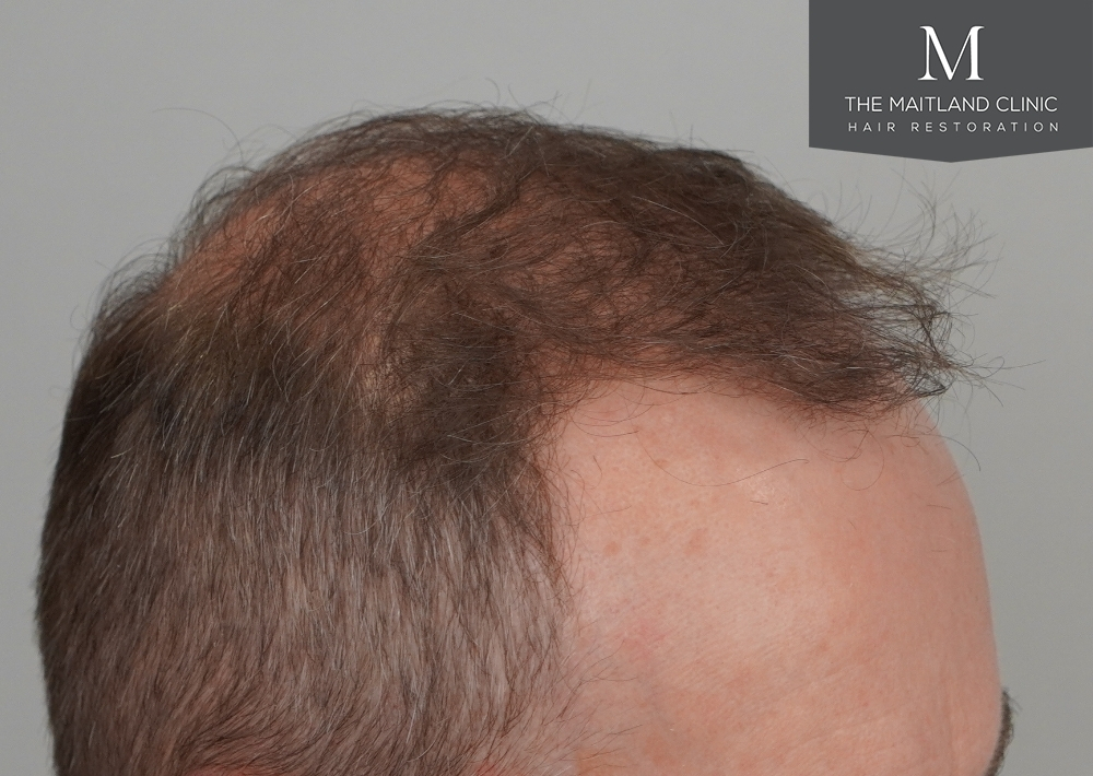 3904 grafts by FUE