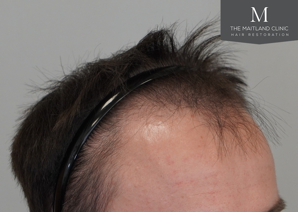 1551 grafts by FUE