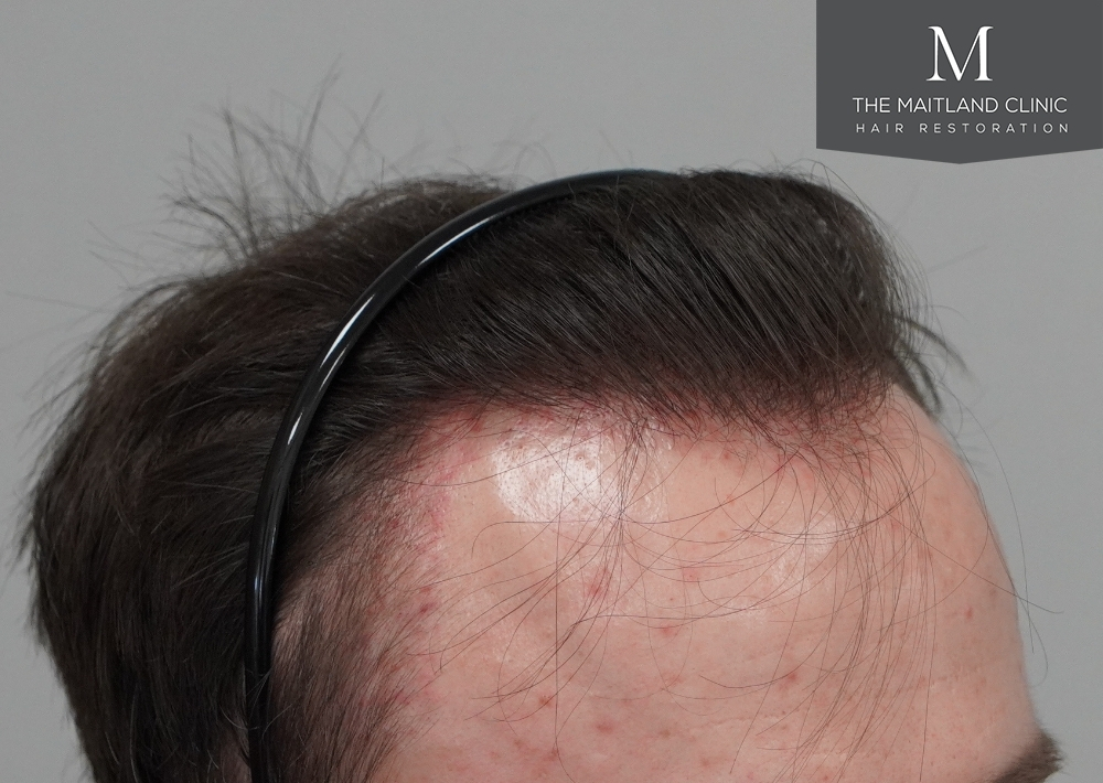 1551 grafts by FUE