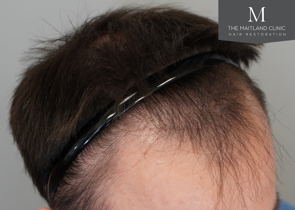 1551 grafts by FUE