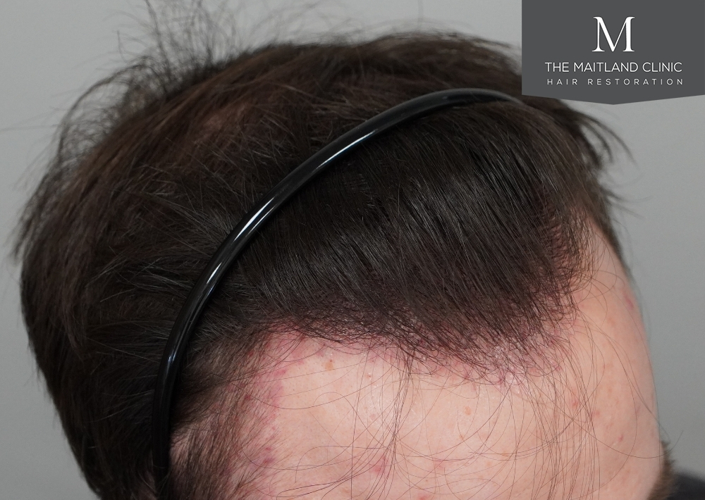1551 grafts by FUE