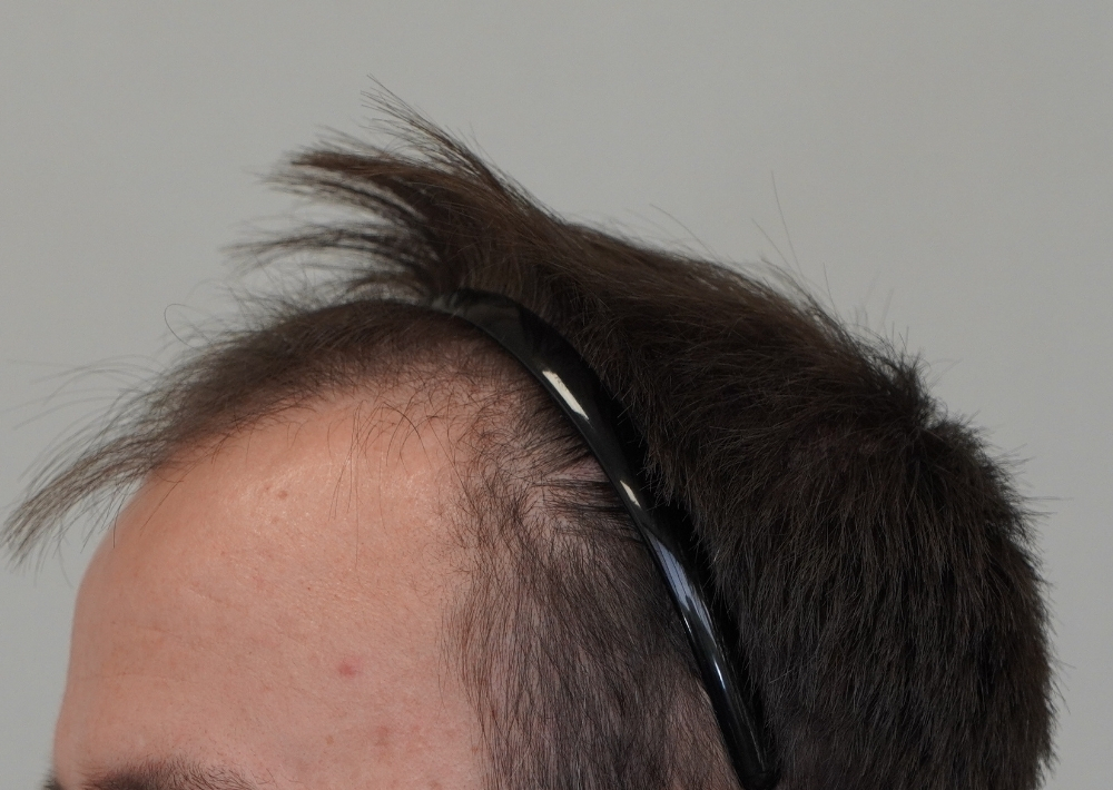 1551 grafts by FUE