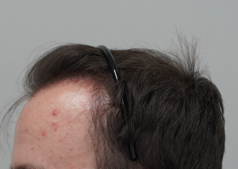 1551 grafts by FUE