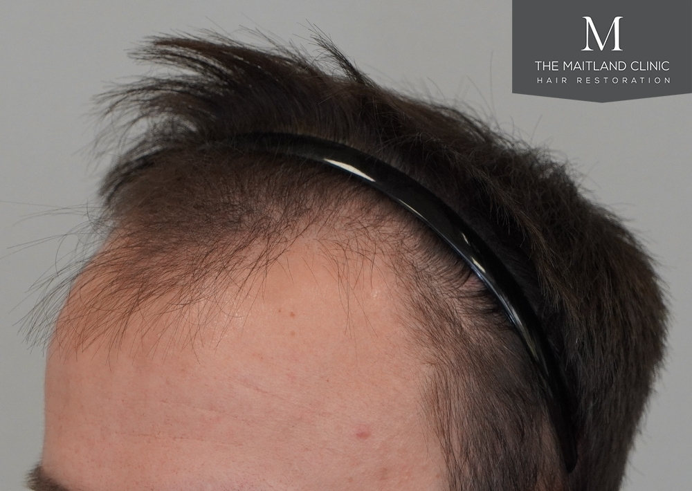 1551 grafts by FUE
