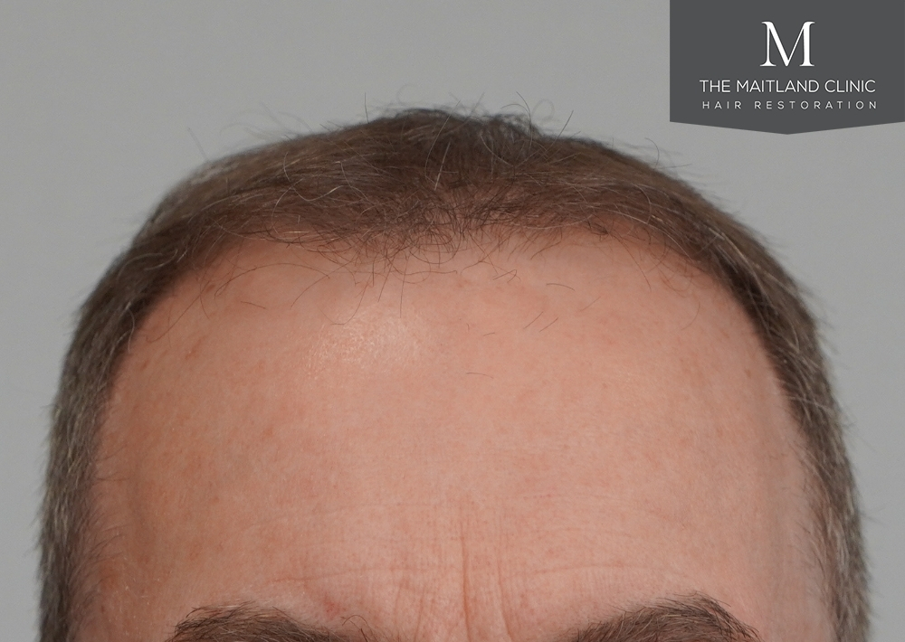 3904 grafts by FUE