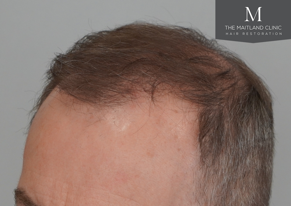 3904 grafts by FUE
