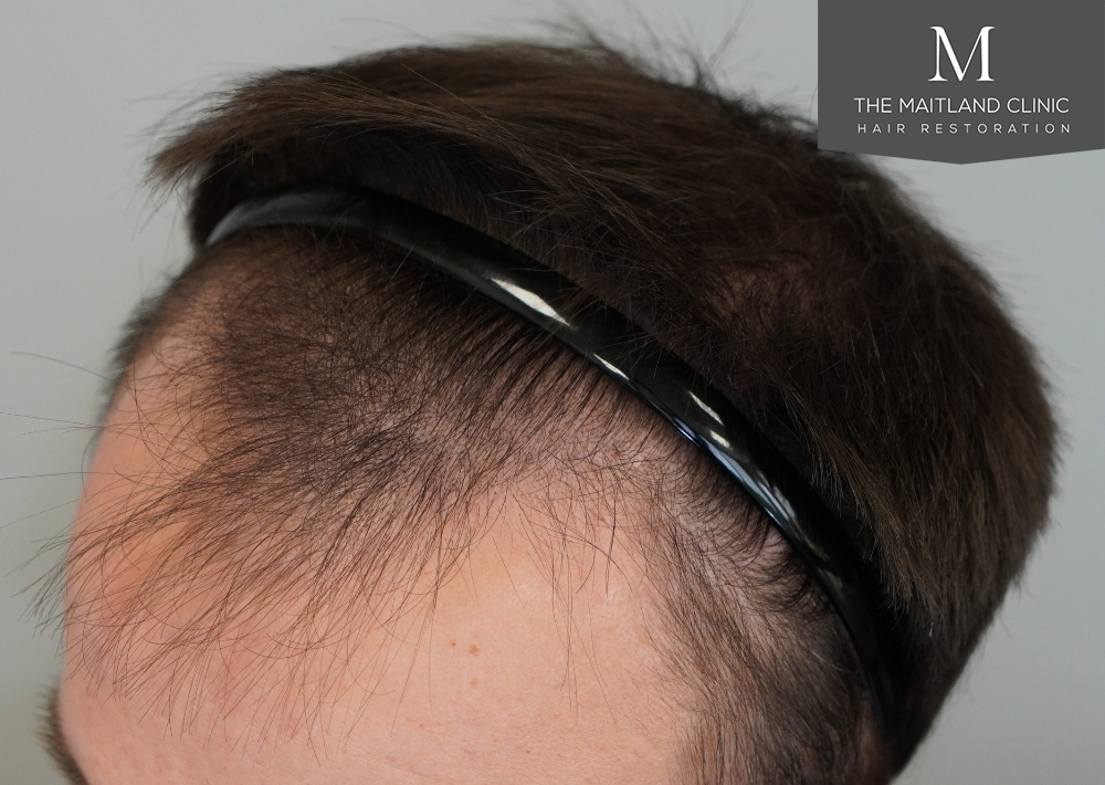 1551 grafts by FUE