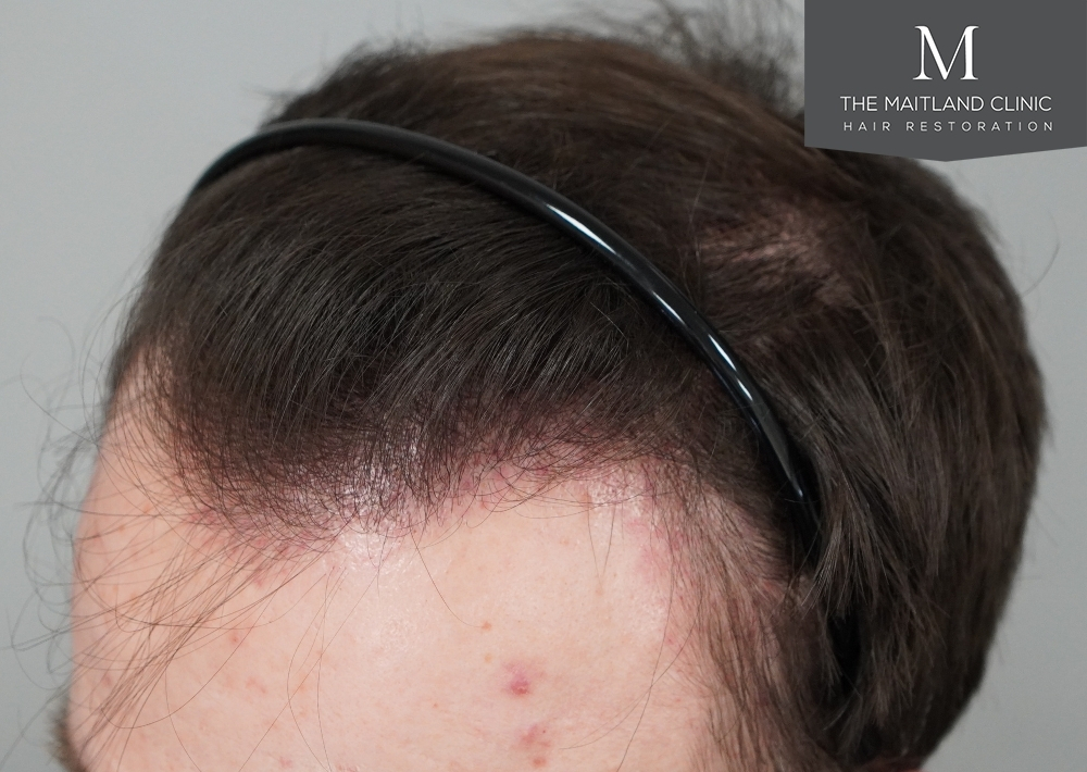 1551 grafts by FUE