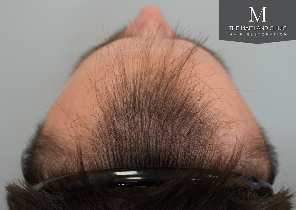 1551 grafts by FUE