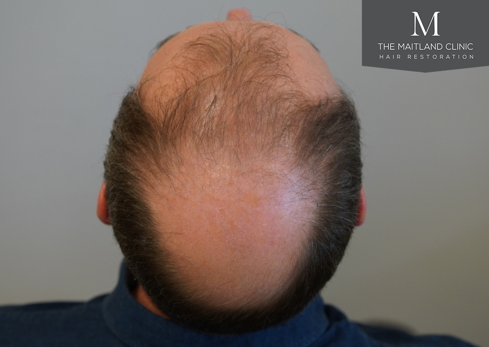 3904 grafts by FUE