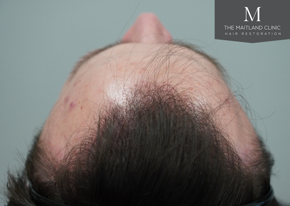 1551 grafts by FUE