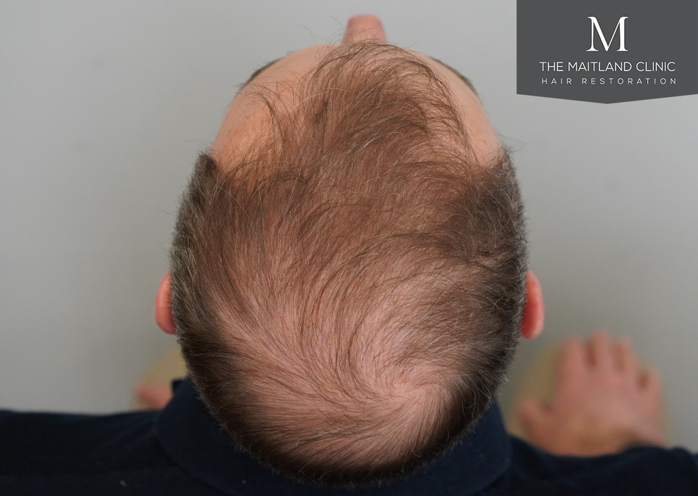 3904 grafts by FUE