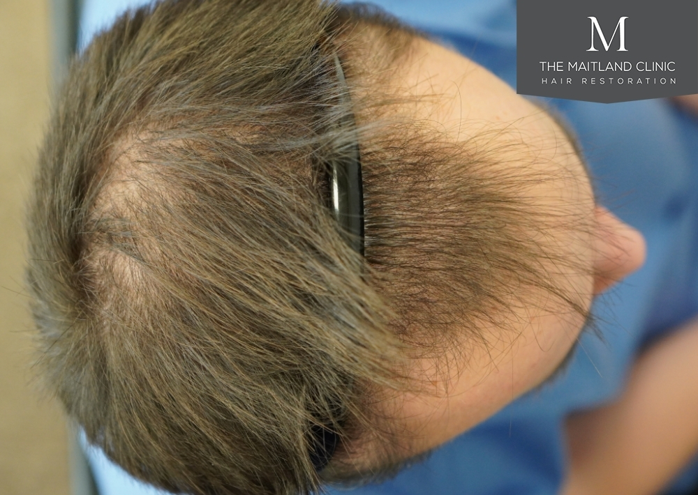 1551 grafts by FUE