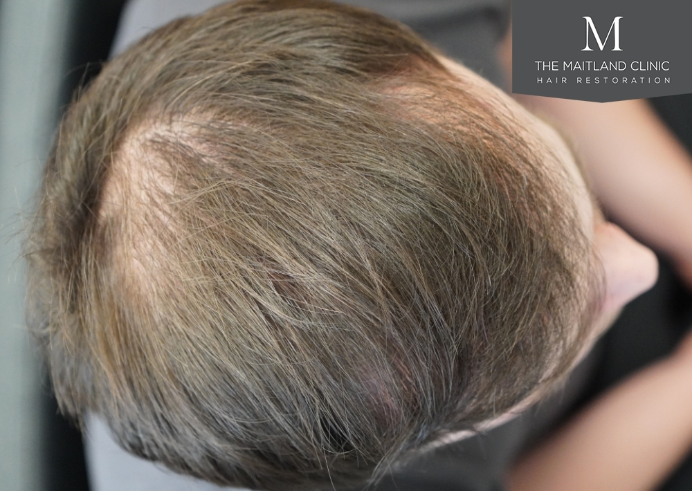 1551 grafts by FUE