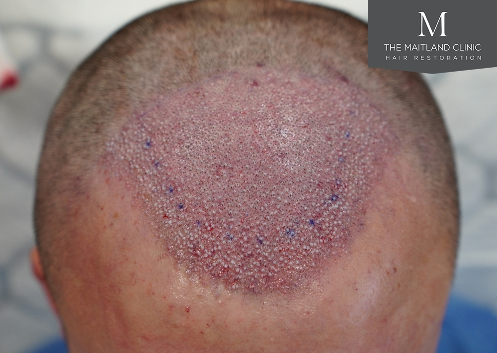 1551 grafts by FUE