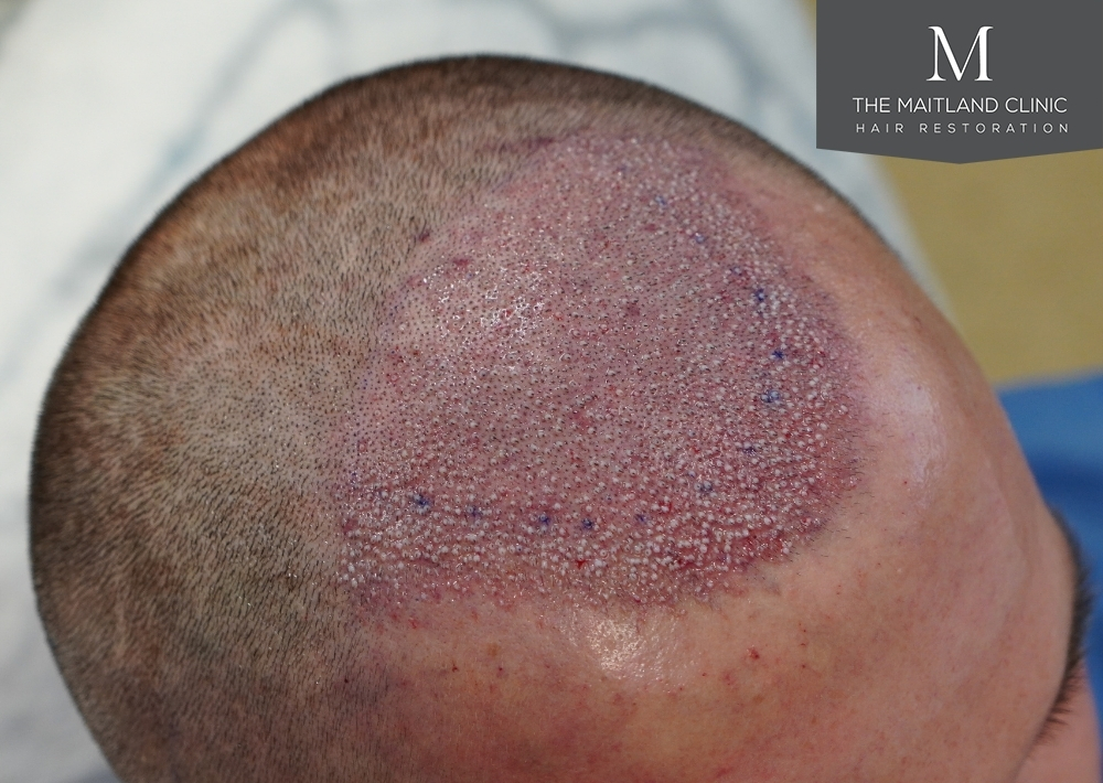 1551 grafts by FUE