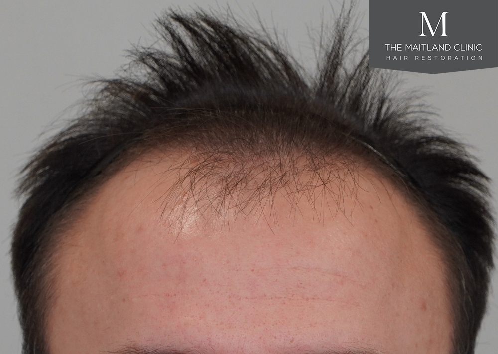 1551 grafts by FUE