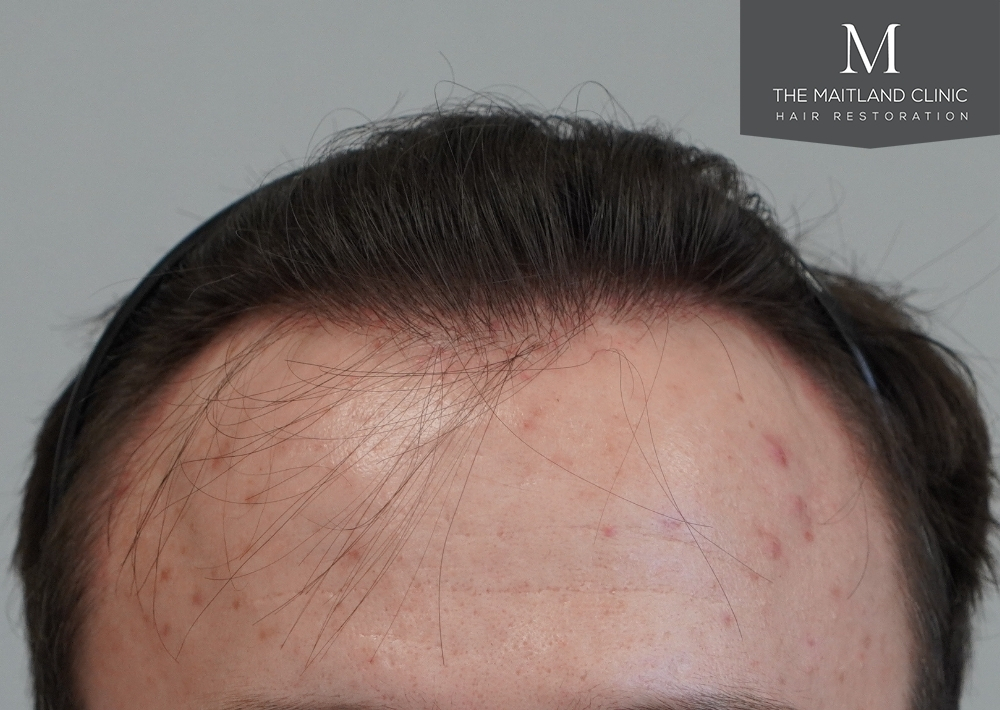 1551 grafts by FUE