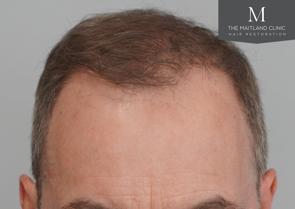 3904 grafts by FUE