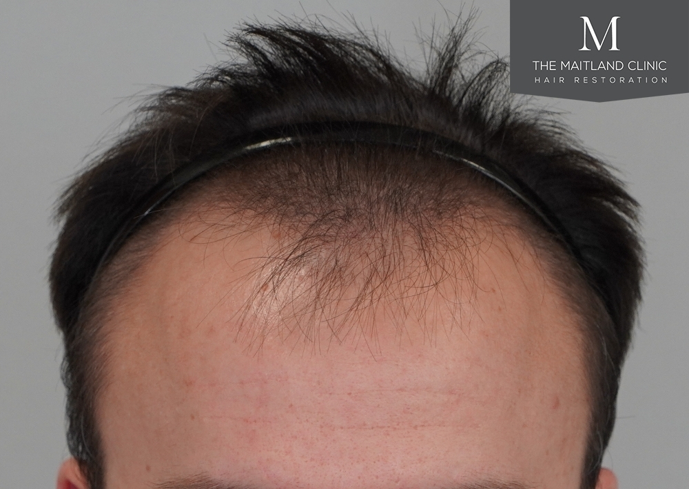 1551 grafts by FUE