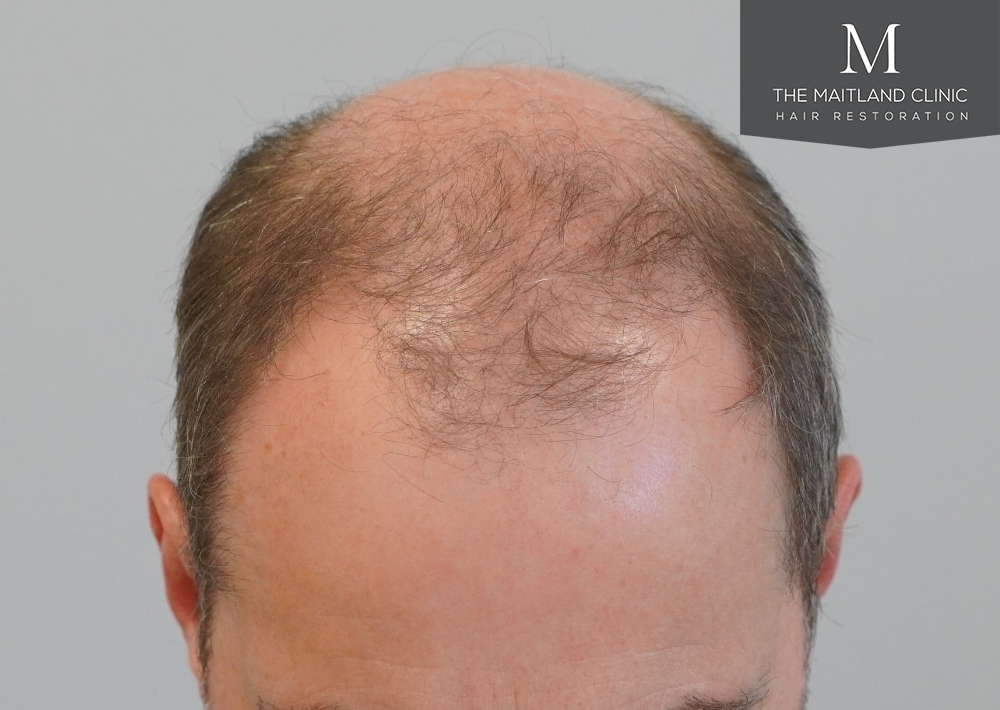 3904 grafts by FUE