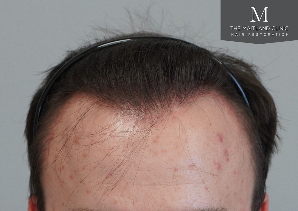 1551 grafts by FUE