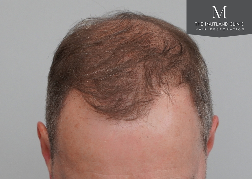 3904 grafts by FUE