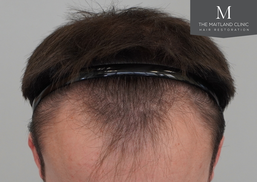 1551 grafts by FUE