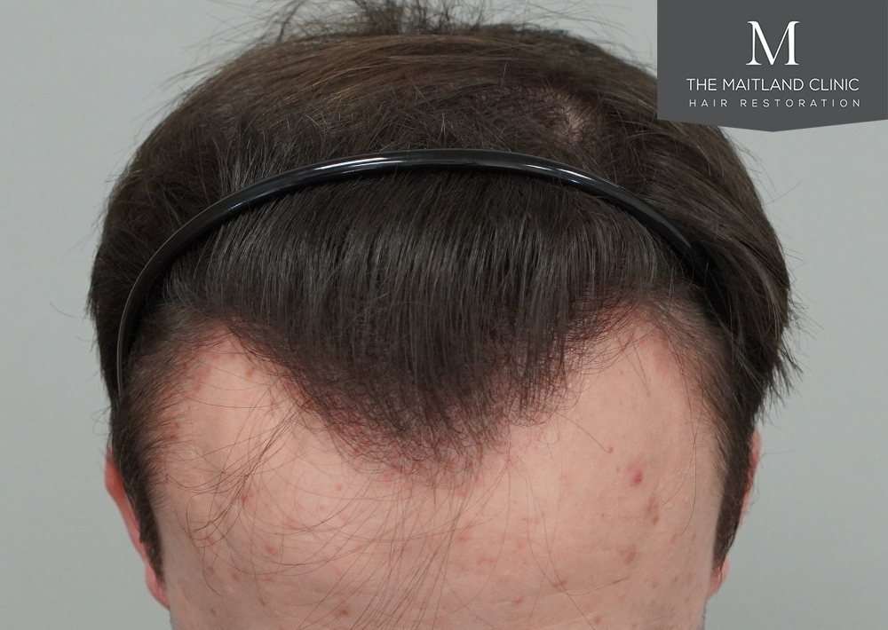 1551 grafts by FUE