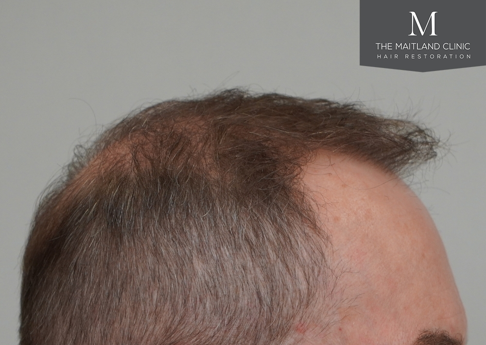 3904 grafts by FUE