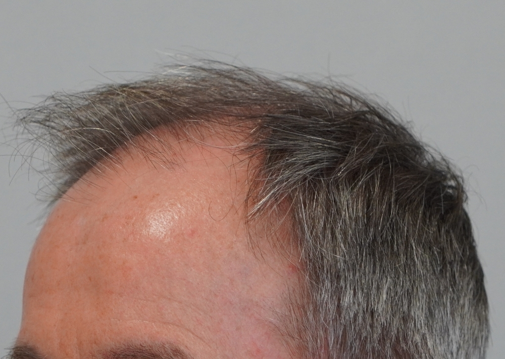 3269 grafts by FUT - The Maitland Clinic