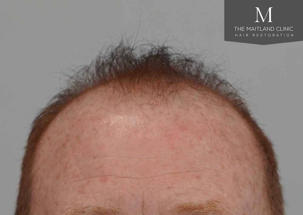 1983 grafts by FUE