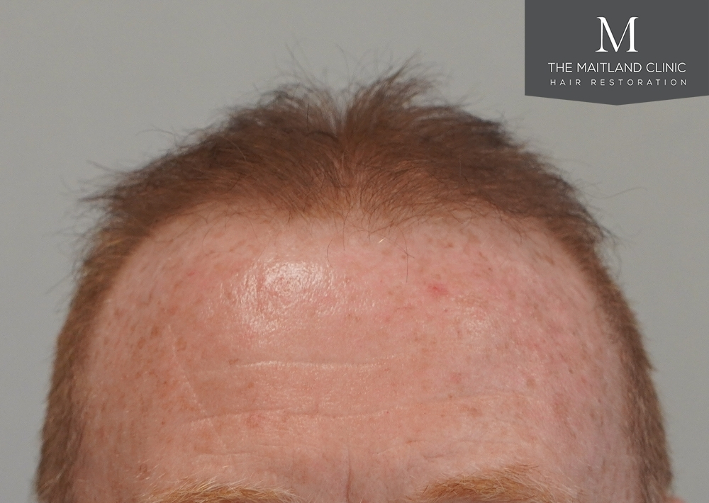 1983 grafts by FUE