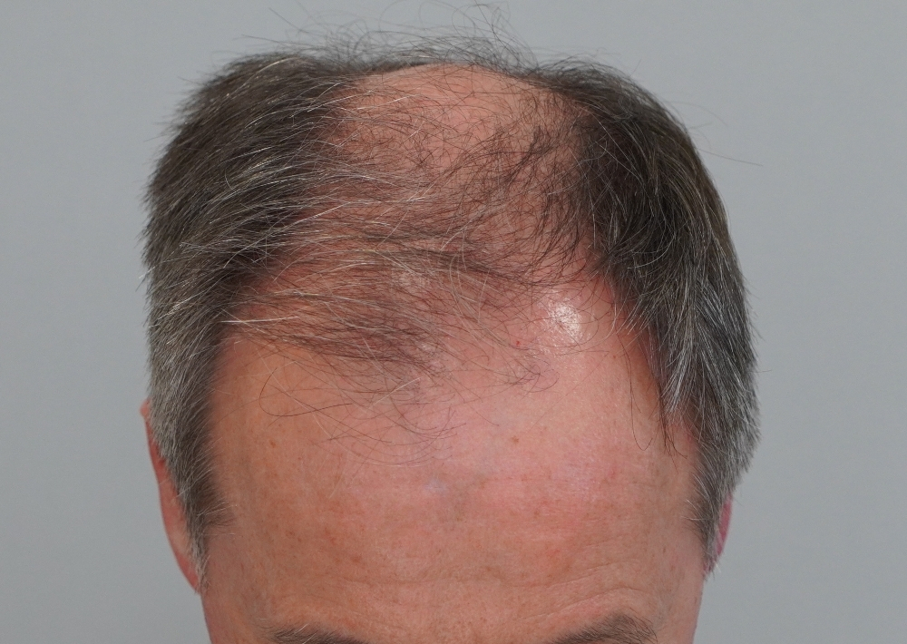 3269 grafts by FUT
