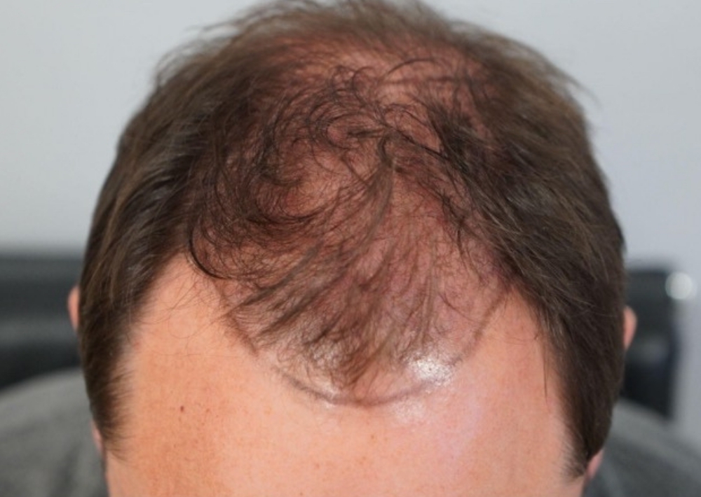 3.5 months topical finasteride with minoxidil hair loss medication