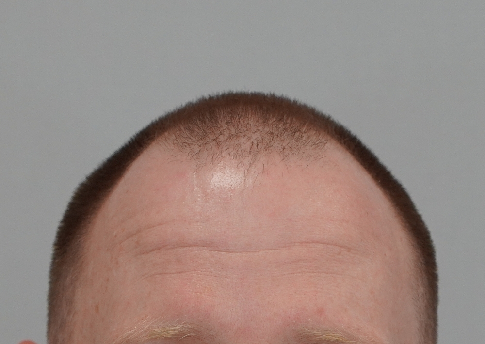 1229 grafts by FUE