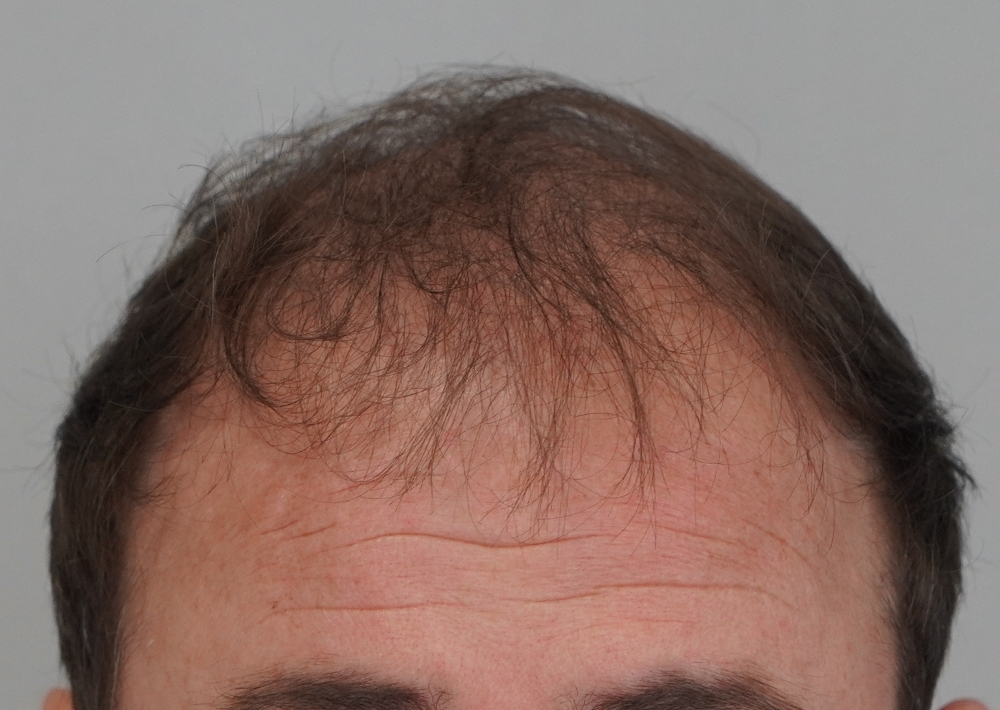 2501 grafts by FUE