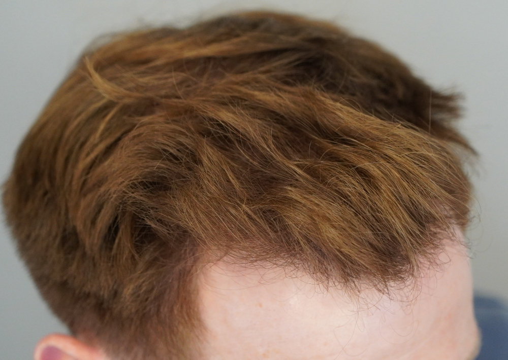 1229 grafts by FUE