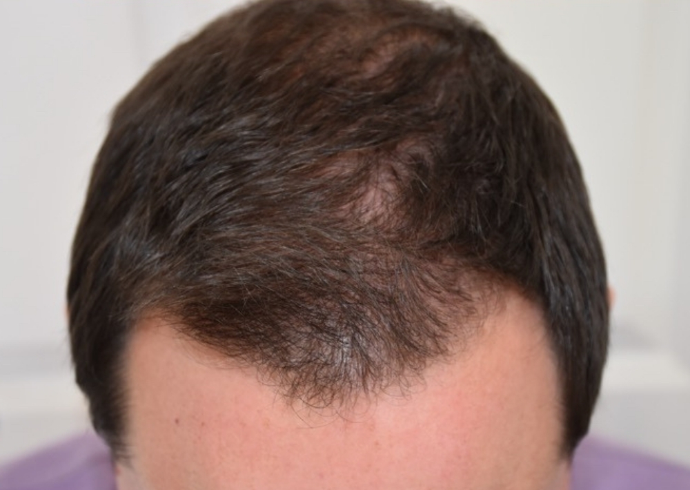 3.5 months topical finasteride with minoxidil hair loss medication