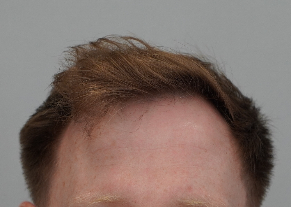 1229 grafts by FUE